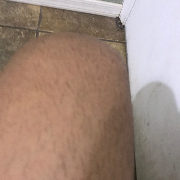 My leg - Picture 1 of 1